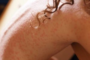 Medicamento inédito para dermatite já está disponível no Brasil