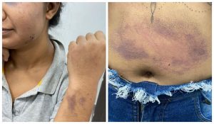 Em Ceilândia, mulher é torturada pelo companheiro durante quase 20 dias