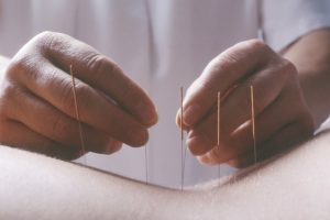 Acupuntura pode aliviar as dores do câncer, segundo revisão de estudos