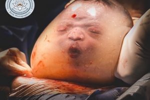 Foto de bebê que nasceu empelicado garante prêmio a brasileira