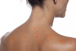 Coronavírus pode causar sintomas na pele?