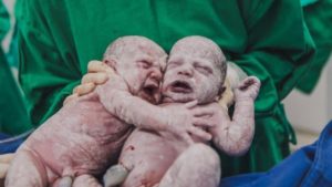Imagem de gêmeas se abraçando após parto viraliza na web