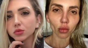Bichectomia: “Minha cara caiu”, diz influencer