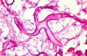 FUNGO NEGRO – MUCORMICOSE