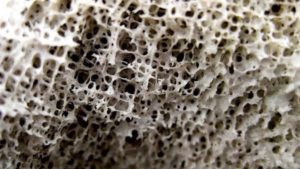 Osteoporose: mitos e verdades da doença