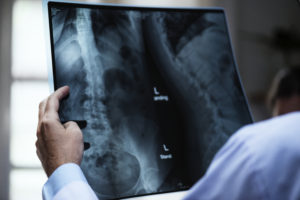 Dia Mundial de Combate à Osteoporose: doença atinge 10 milhões de brasileiros  